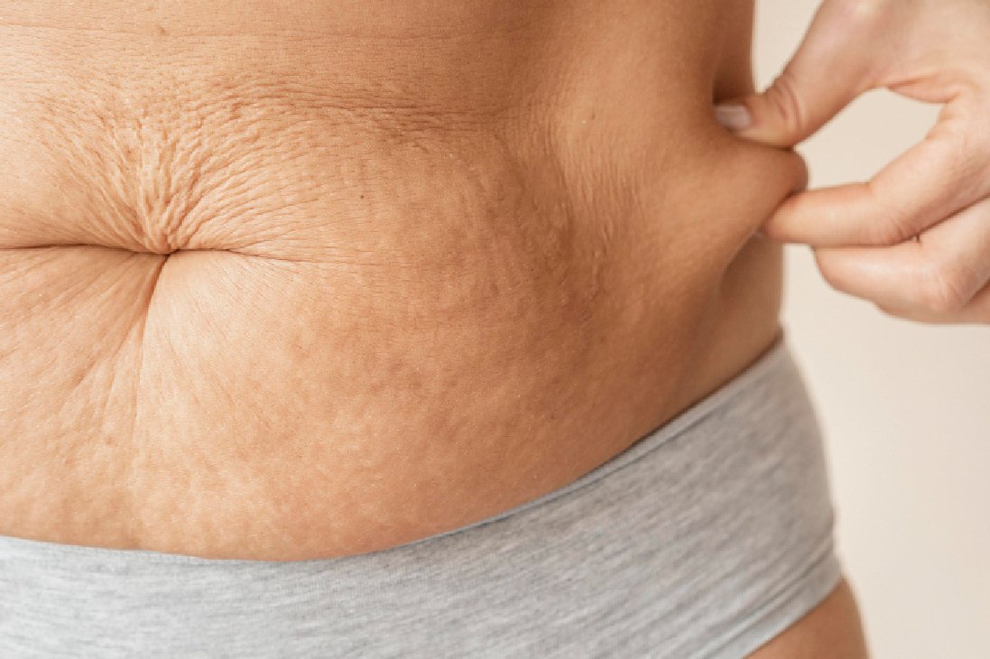 Stretch Marks Treatment In Bangalore